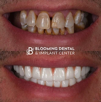 Full mouth reconstruction before and after