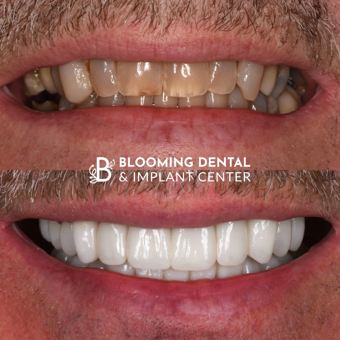Comprehensive rejuvenation dentistry before and after